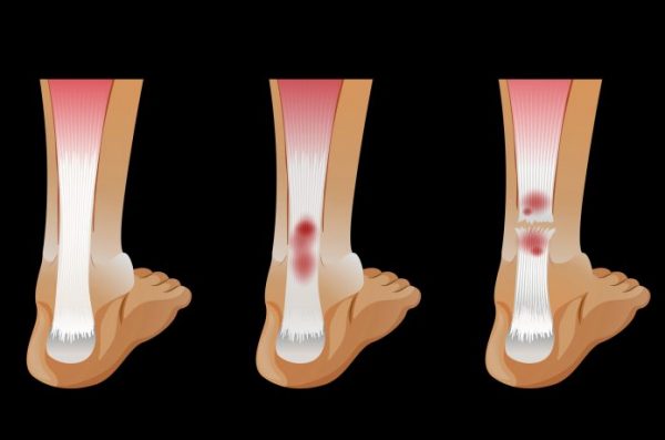 アキレス腱　痛み　種別