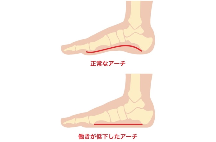 正常なアーチと働きが低下したアーチ