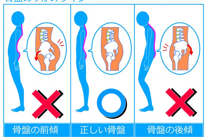 骨盤の歪みを表す図